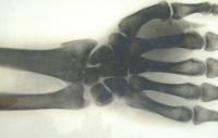 Wrist fracture x ray hickman archive hsm 237x150 wrist fracture x ray hickman archive hsm 237x150